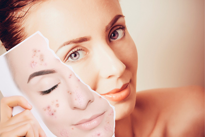 Лечение акне в домашних условиях лазером УзорМед-405