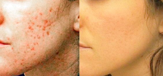 Лечение акне, угрей, угревой сыпи.